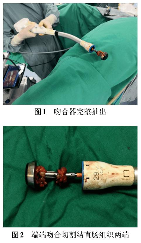 包皮环切吻合器手术多久可以把纱布去掉术后纱布留体内4年还能用吗刚做完宫颈活检3小时后取出纱布行吗，因为在里面不舒服